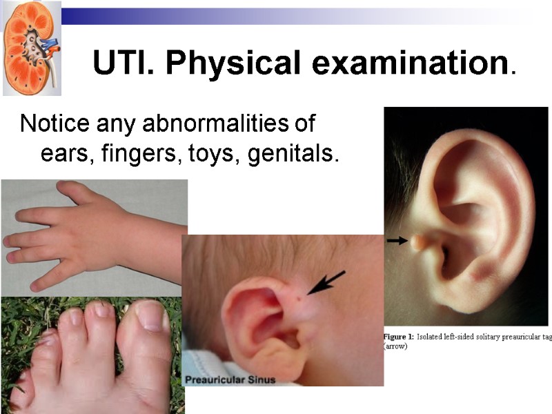 UTI. Physical examination. Notice any abnormalities of ears, fingers, toys, genitals.